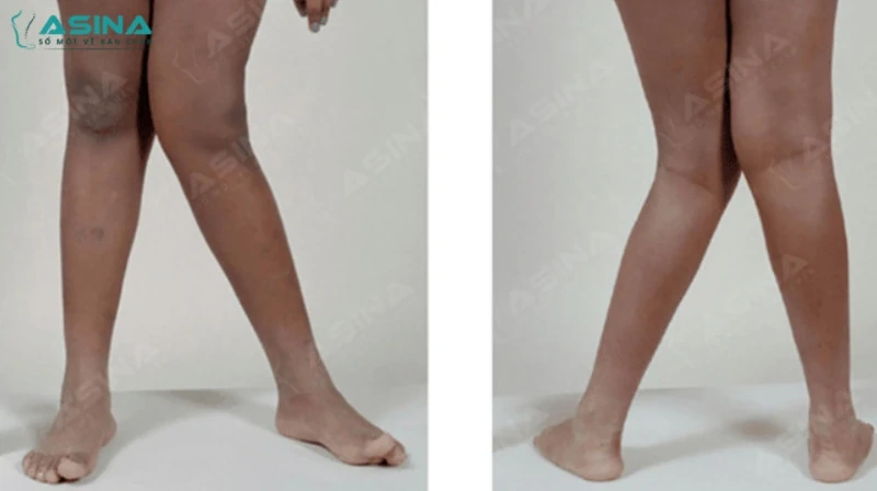 Làm thế nào để phân biệt chân chữ X sinh lý và chân chữ X bệnh lý?