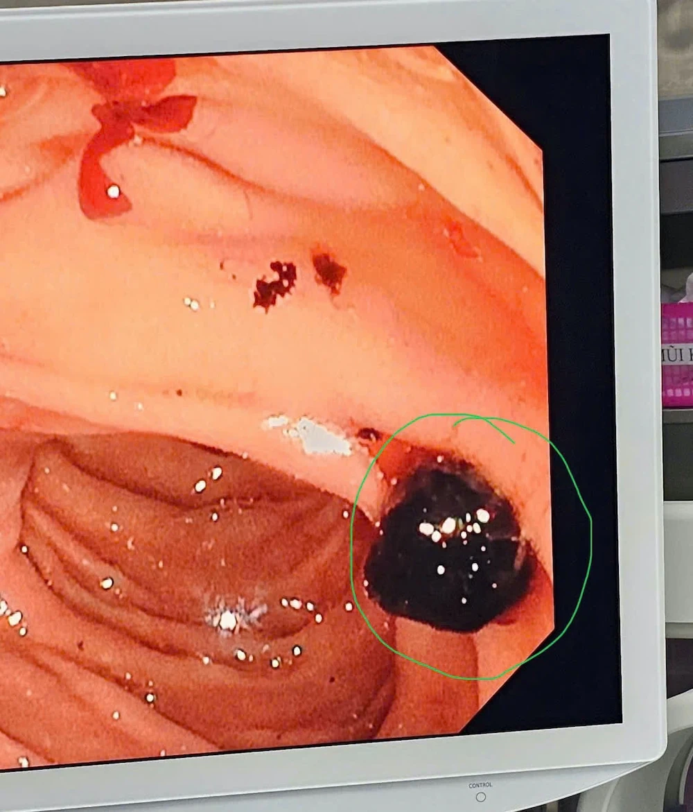 Bệnh viện Đa khoa tỉnh Thanh Hóa triển khai hiệu quả kỹ thuật nội soi mật tụy ngược dòng can thiệp