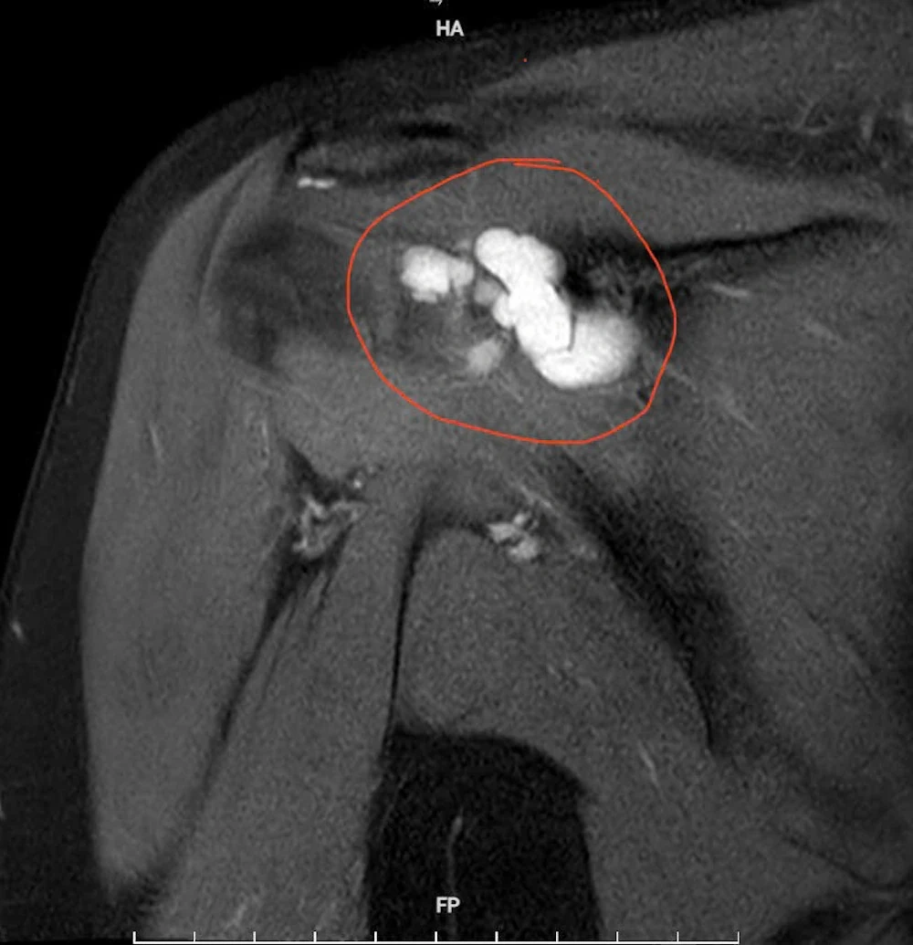 Phẫu thuật nội soi thành công ca u bao hoạt dịch khớp vai hiếm gặp