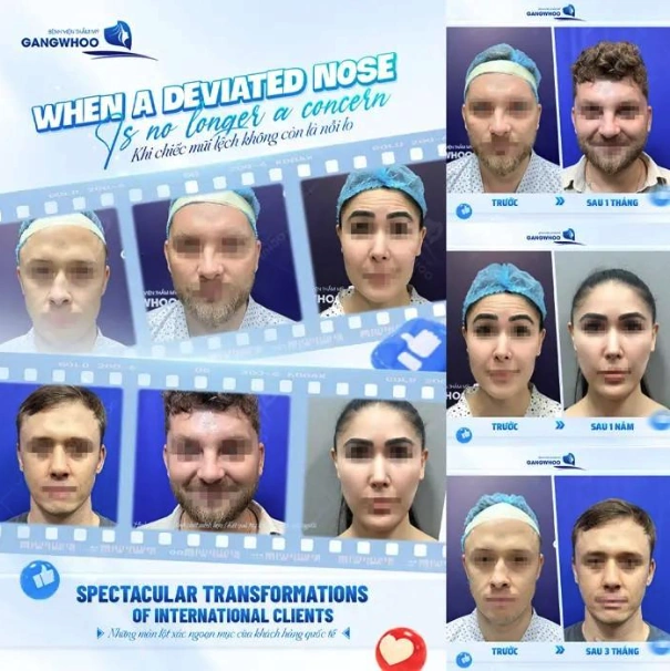 Bệnh viện thẩm mỹ Gangwhoo top địa chỉ sửa mũi hỏng tại TPHCM