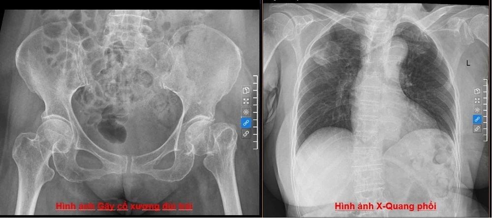 Tỷ lệ tử vong tới 30% sau gãy cổ xương đùi ở người cao tuổi: Vì sao cần điều trị sớm?