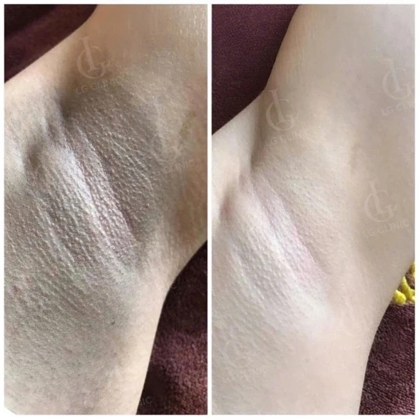 Xoá sổ thâm nách & da gà sần sùi: Hiệu quả kép giúp Deep L-Picosure dẫn đầu thị trường thẩm mỹ