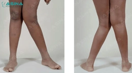 Làm thế nào để phân biệt chân chữ X sinh lý và chân chữ X bệnh lý?