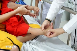 Yêu cầu tăng cường thu dung, điều trị khi ca mắc tay chân miệng tăng mạnh