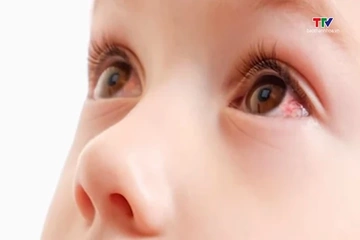 Bộ Y tế cảnh báo dịch bệnh do Adenovirus và đau mắt đỏ