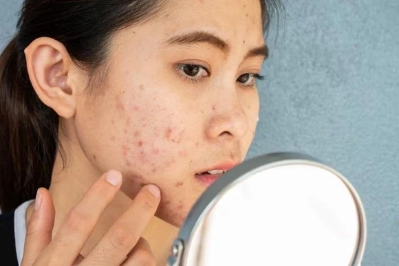 Bị nổi mụn mãi không hết - Đừng vội bỏ qua bài viết này!