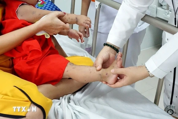 Tăng cường công tác phòng, chống bệnh tay chân miệng trên địa bàn tỉnh