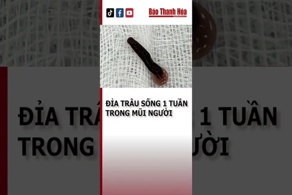 KINH HOÀNG: ĐỈA TRÂU SỐNG 1 TUẦN TRONG MŨI NGƯỜI | Báo Thanh Hóa