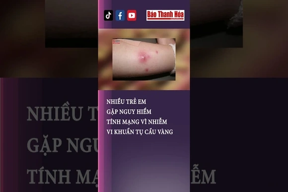 Nhiều trẻ em gặp nguy hiểm tính mạng vì nhiễm vi khuẩn tụ cầu vàng | Báo Thanh Hóa