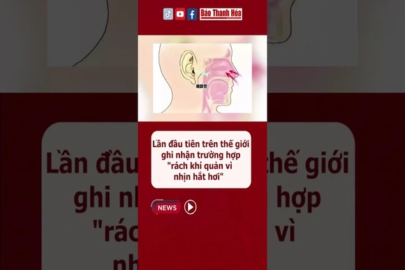 Lần đầu tiên trên thế giới ghi nhận trường hợp“rách khí quản vì nhịn hắt hơi”