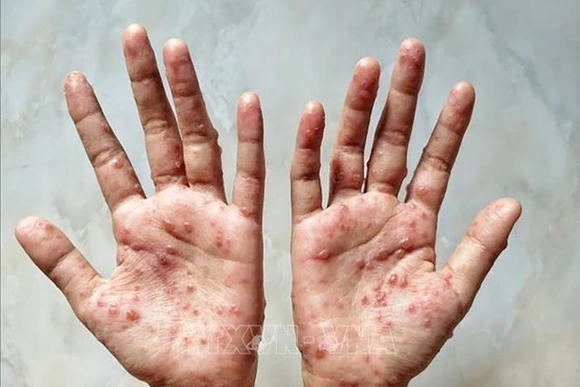 Tăng cường phòng, chống bệnh Đậu mùa khỉ trên địa bàn tỉnh Thanh Hóa