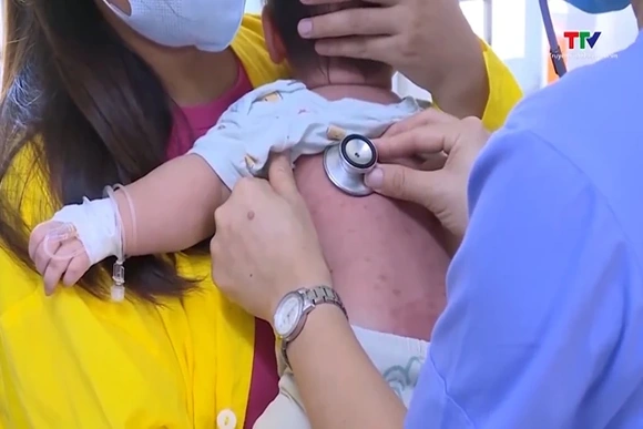 Sởi ở trẻ em: Nhận biết sớm, phòng biến chứng nguy hiểm