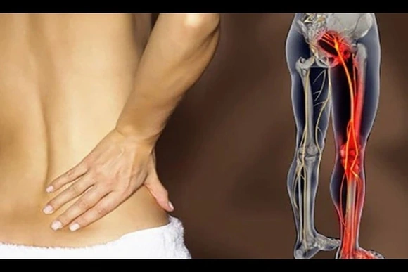 Đau dây thần kinh tọa và những điều cần biết