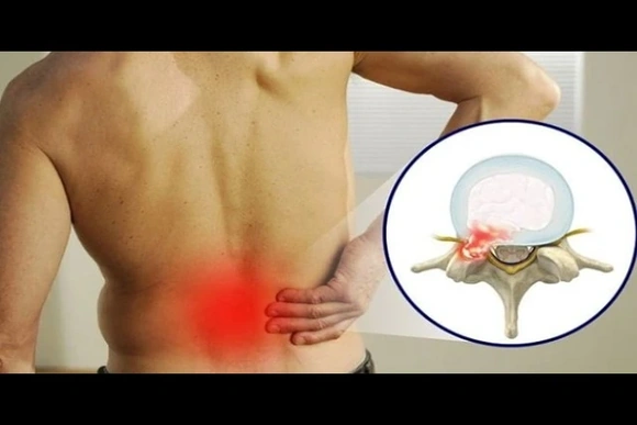 Thoát vị đĩa đệm ở người trẻ và những điều cần lưu ý